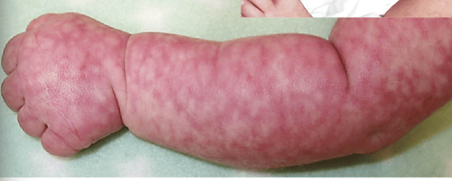 <p>- transient vasomotor mottling</p><p>- most visible if cold</p><p>- disappears with warming</p>