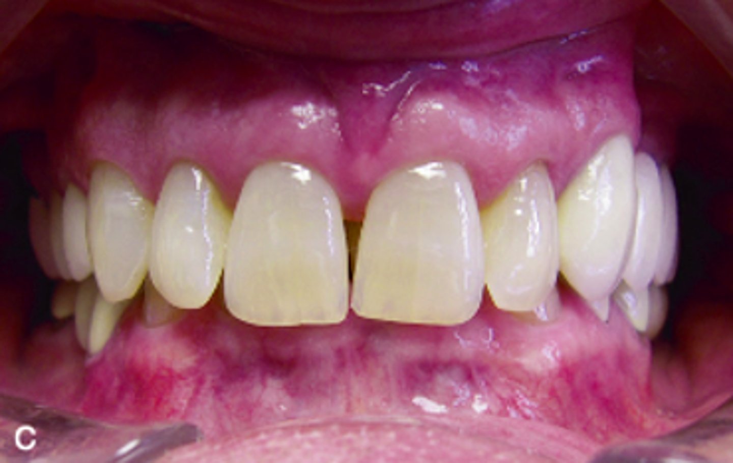 <p>ID the occlusion classification:</p>