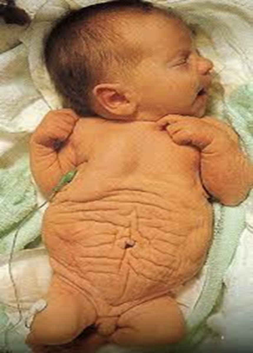 <p>Eagle-Barrett / Prune Belly</p>