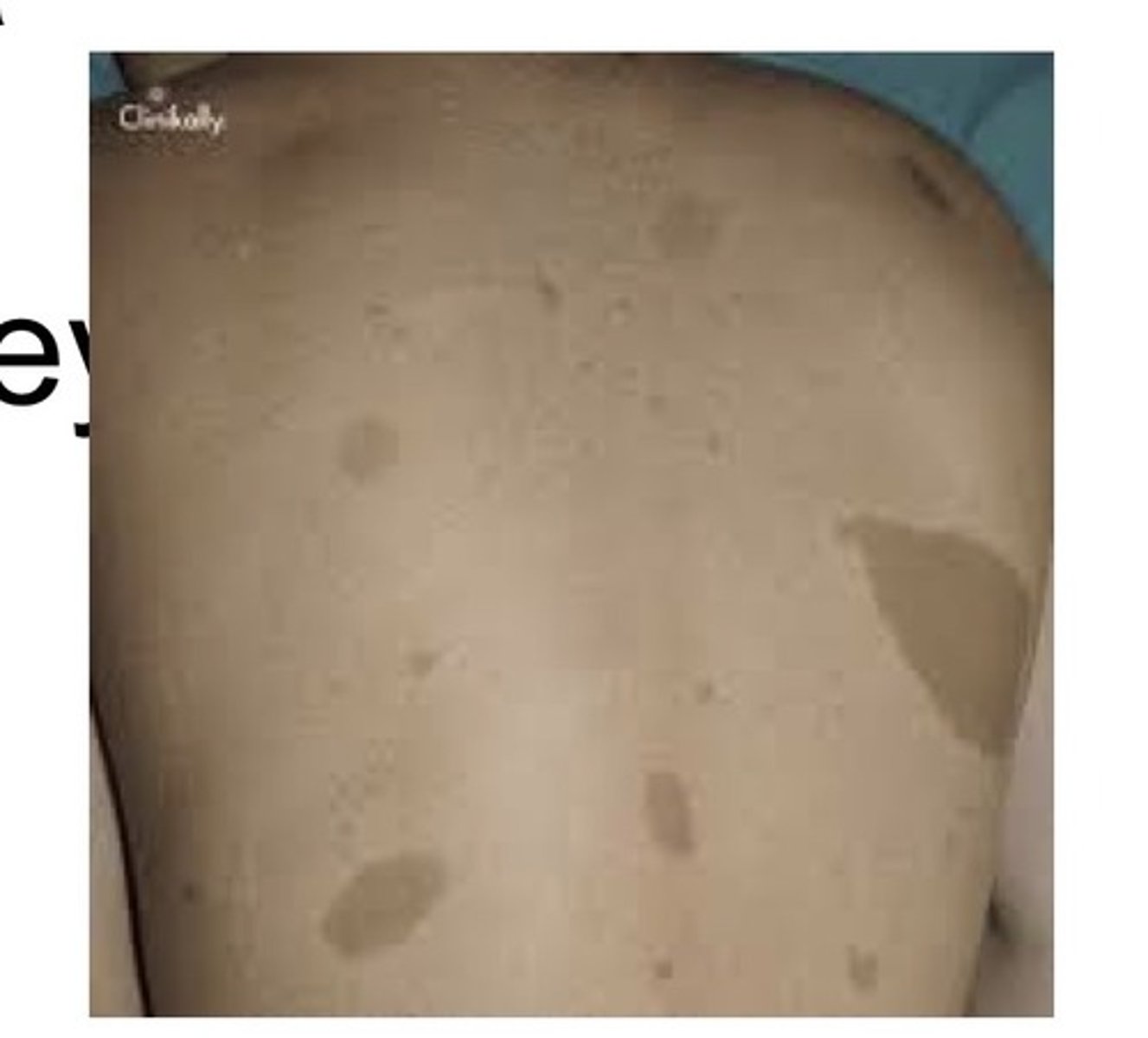 <p>Characterized by involvement of more than one bone. Typically occurs in children with a female predilection. When long bones are involved, they may exhibit bowing and an associate dull aching pain. Patients may have skin lesions appearing as light brown macules called cafe au lait spots.</p>