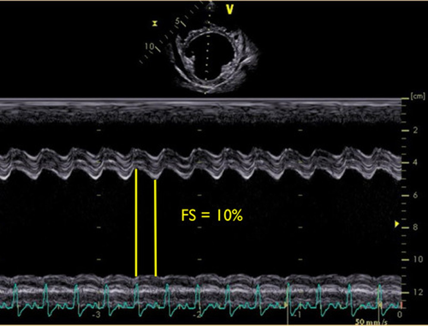 <p>does this show normal or abnormal cardiac function? why?</p>