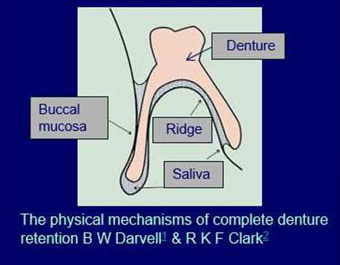 <ul><li><p>Saliva layer between dentures and underlying soft tissues help to make a<strong> seal </strong>around the dentures to give <strong>suction</strong> -<strong> peripheral seal </strong></p></li></ul><p></p>