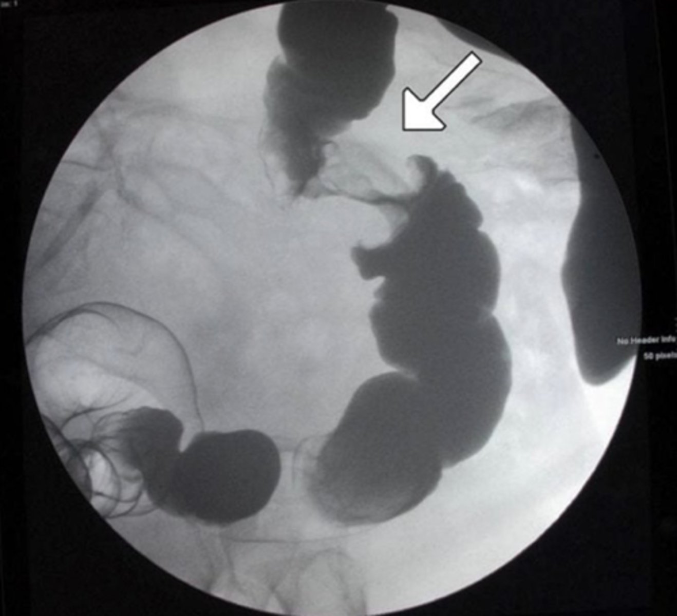 <p>Colonoscopy—Gold standard</p><p>- Apple-core appearance</p>