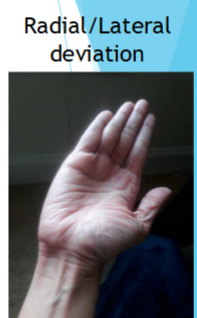 <p>Movement of wrists towards the lateral side</p><p><em>Doing that too much radiates pain</em></p>