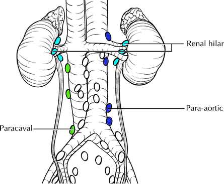 <ol><li><p>tends to mets to lungs</p></li><li><p>The following lymph nodes are usually positive at diagnosis:</p><ol><li><p>Renal Hilar nodes</p></li><li><p>Para-aortic nodes</p></li></ol></li></ol><p></p>