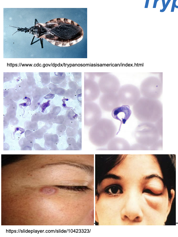 <ul><li><p class=""><strong>Detection of trypomastigotes in blood</strong></p><ul><li><p class="">Blood smears</p></li><li><p class="">Fluorescent staining</p></li></ul></li><li><p class="">Along with <strong>clinical presentation</strong></p></li></ul><p></p>