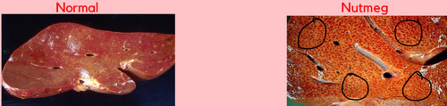 <p>Liver with mottled red + yellow appearance due to chronic passive congestion + central lobular hypoxia</p>