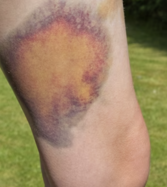 <p>what type of vascular skin lesion is this?</p>