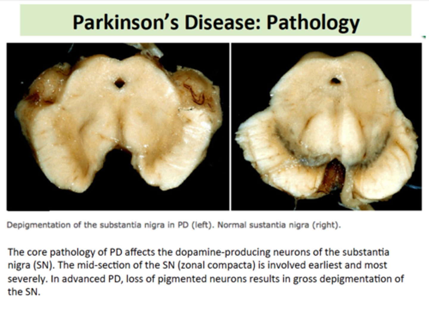 <p>PD involves the malfunction and death of vital dopamine-producing neurons in the substantia nigra of the basal ganglia. Symptoms appear when approximately 80% of stored dopamine is depleted.</p>