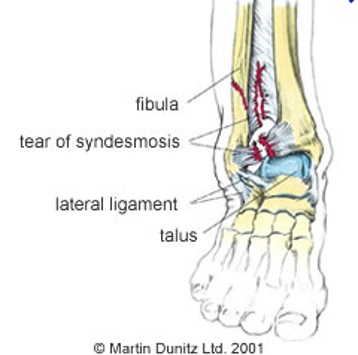 <p>involves the syndesmotic ligaments between the tibia &amp; fibula</p><p>- &lt; 10% of all sprains</p><p>- take longer to heal</p>