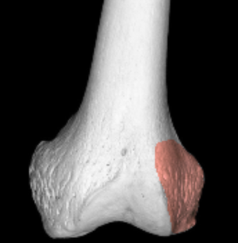<p>large bump on lateral side of femur </p>