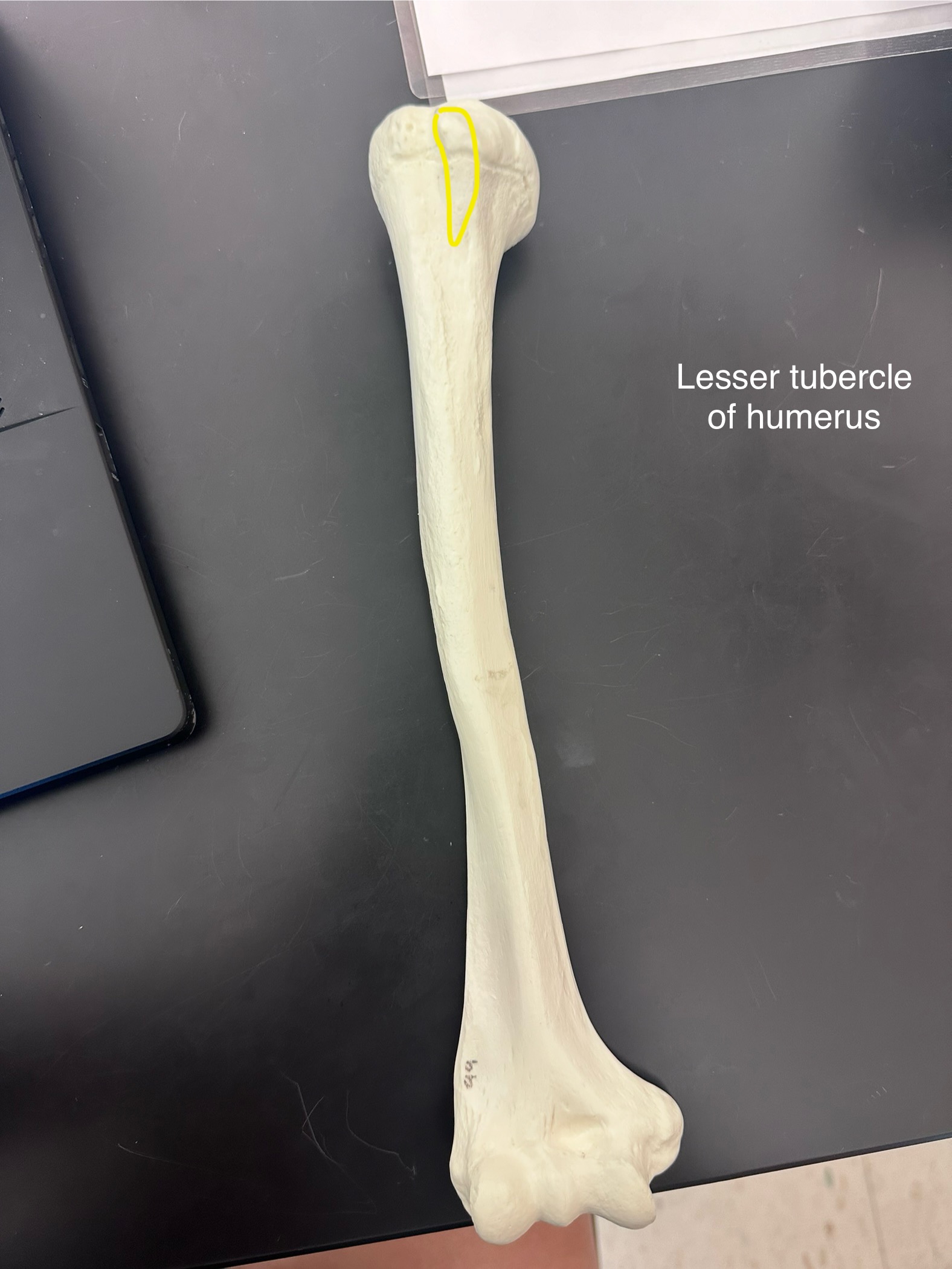 <p>Lesser Tubercle of humerus</p>