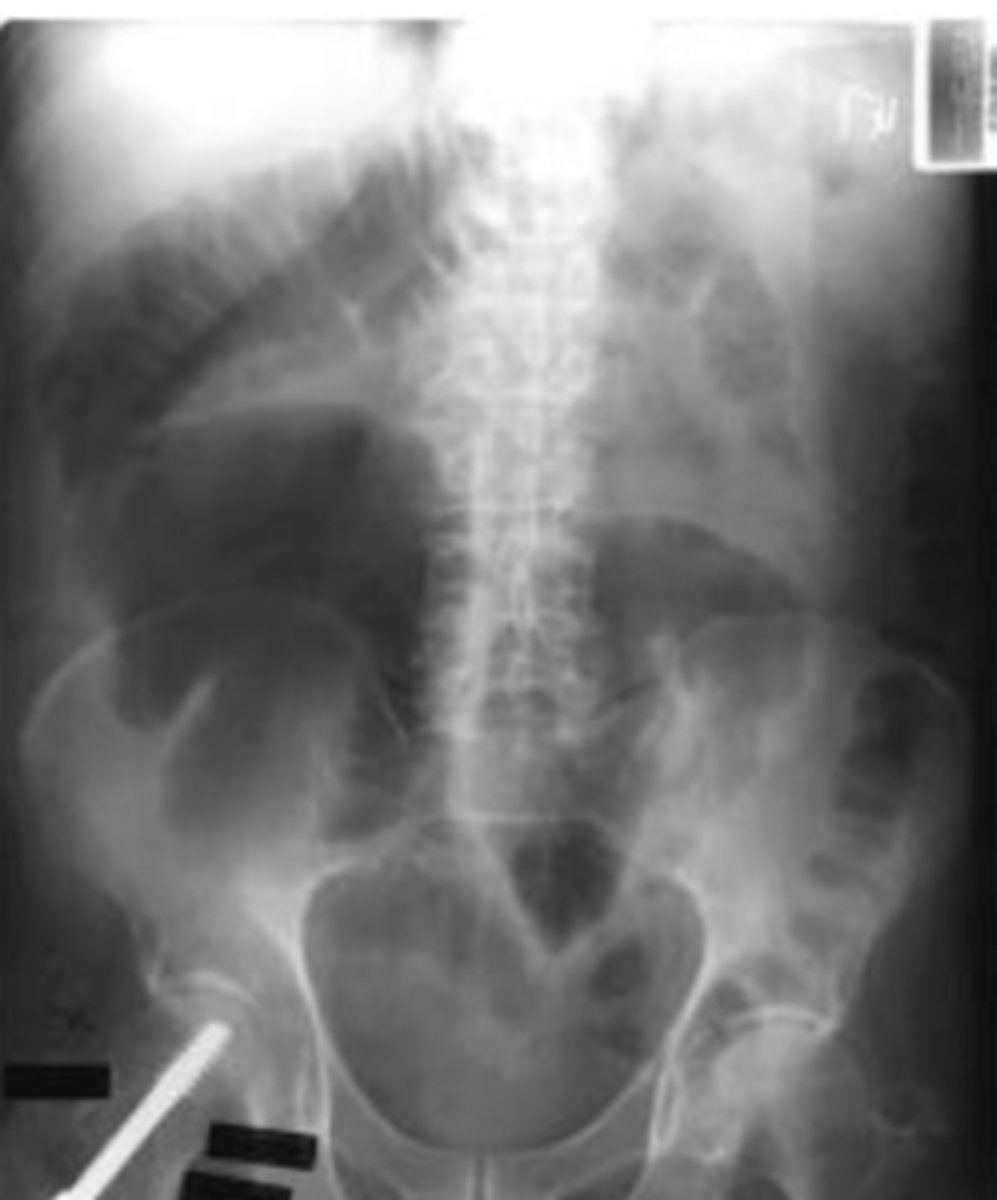 <p>older immobile patient on medications</p>