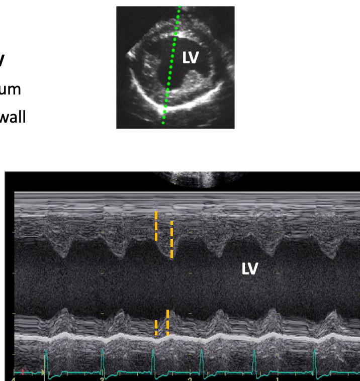 <ol><li><p><u>Cardiac Wall thickness:</u></p></li></ol><p><strong>⢠RPS short axis through LV</strong></p><p>⢠Interventricular septum</p><p>⢠Left ventricular free wall</p><p>⢠Published values for thickness for breeds and species</p><ol start="2"><li><p><u>LV function:</u></p></li></ol><p><strong>⢠RPS short axis through LV</strong></p><p>⢠LV Lumen diameter</p><p>⢠Same trace as wall thickness</p><p><strong>Shortening fraction: </strong>gives information on the contractility ability of the left ventricle - <span>measures the percentage decrease in left ventricular (LV) diameter during systole, representing systolic function</span></p><p><u>⢠LVEDD - LVESD à 100</u></p><p>LVEDD</p><p>⢠Normal range : Dogs: 25 - 45% Cats : 30 - 55%</p><p><strong>⢠RPS long axis through LV & LA - taken using B-mode</strong></p><p>⢠LV Lumen diameter</p><p>⢠End diastole image stopped - MV open / max area</p><p>⢠End systole image stopped - MV closed / min area</p><p>Ejection fraction: also gives information on LV contractility and function, should be more accurate than shortening fraction</p><p>⢠Difference between areas</p><p>⢠Normal >50%</p><ol start="3"><li><p><u>Left ventricular dilation: gives information on LV volume overload or dilation</u></p></li></ol><p><strong>⢠RPS short axis "Fishmouth" view</strong></p><p>⢠Demonstrates movement of mitral valve leaflets</p><ul><li><p>M & W shapes of the leaflets</p></li></ul><p>⢠LV wall</p><p><strong>E -point to septal separation (EPSS): </strong>E-point to septal separation (EPSS) is an M-mode echocardiographic measurement that <strong><mark data-color="rgba(0, 0, 0, 0)" style="background-color: rgba(0, 0, 0, 0); color: inherit;">provides a rapid, reliable, and mostly objective assessment of left ventricular (LV) systolic function</mark></strong><span><span>.</span></span></p><p>⢠Distance between valve and IVS</p><p>⢠Normal <7mm</p><ol start="4"><li><p><u>Measurement of left atrial size: Left atrial enlargement:</u></p></li></ol><p><strong>⢠RPS short axis through heart base</strong></p><p>⢠End systole</p><p>⢠Left atrium diameter</p><p>⢠Aorta diameter</p><p>⢠Mercedes - Benz sign</p><p>Ratio LA : Aorta</p><p>Dogs 1:1-1.4</p><p>Cats 1: 1.2-1.7</p>