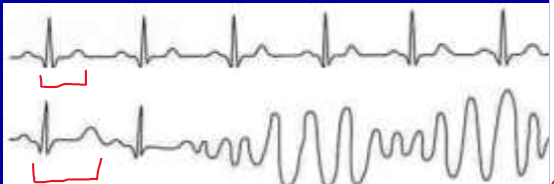 <p>What 2 rhythms are present on this ECG?</p>