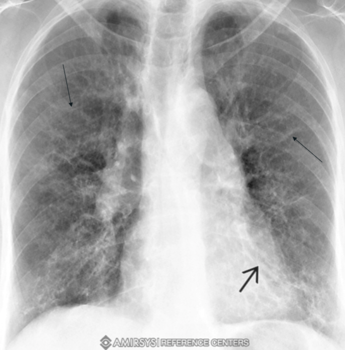 <p>often normal or shows nonspecific findings. Later signs include tram-tracking and honeycomb infiltrates in the medial aspects of lower lobes</p><p></p>