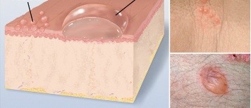 <p>cavity of so-called free fluid, elevated and up to 1cm in size, ‘blister’</p>