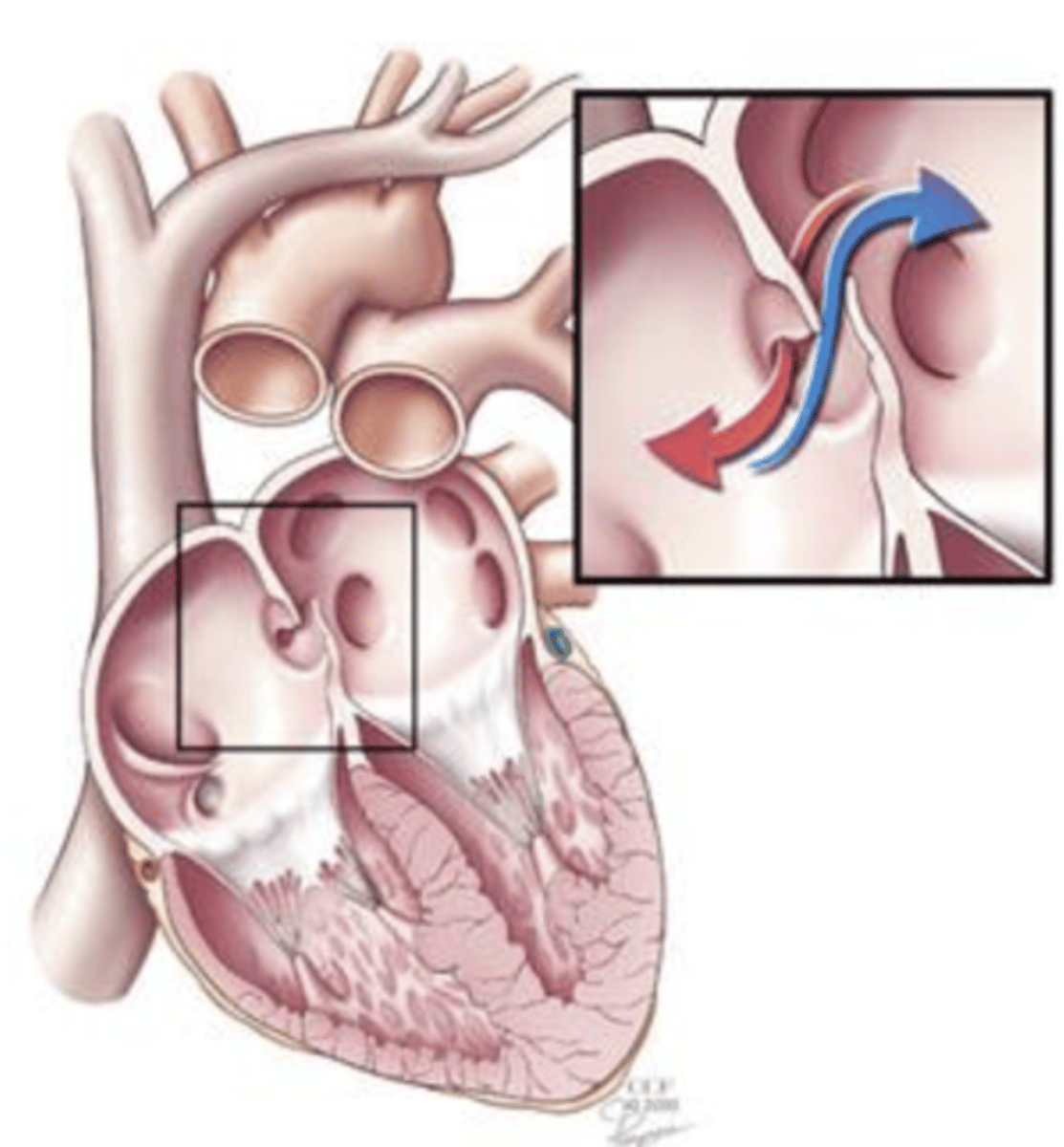 <p>The fossa ovalis is a remnant of a foramen that, in the fetal stage of development, existed between the right and left atrium called the ___ ___ that normally closes at birth.</p>