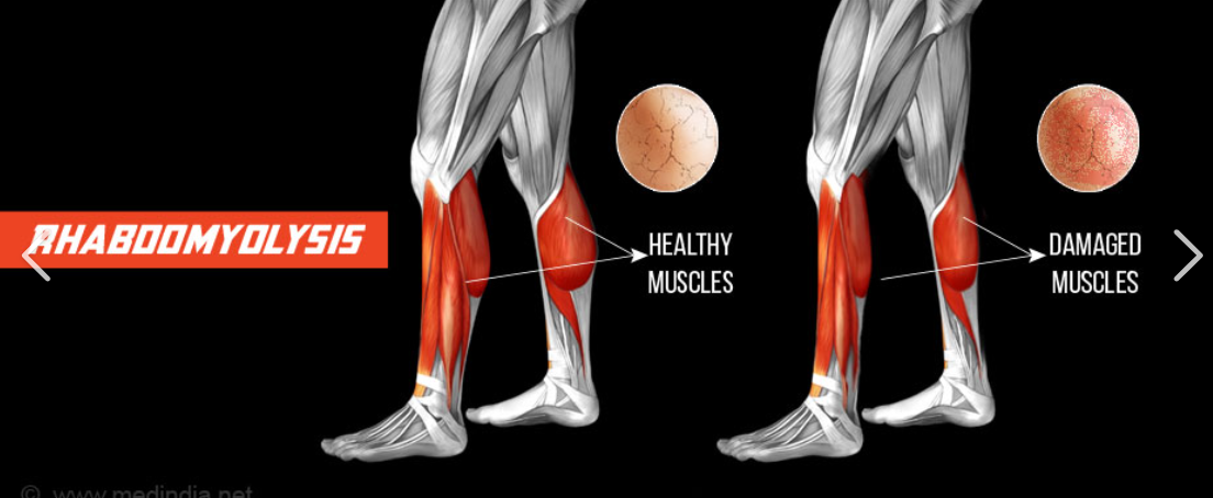 <p>what is rhabdomyolysis?</p>