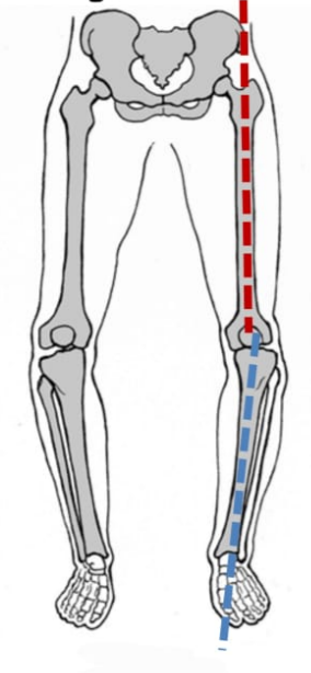 <p>Varus knee (bow-legged)</p>