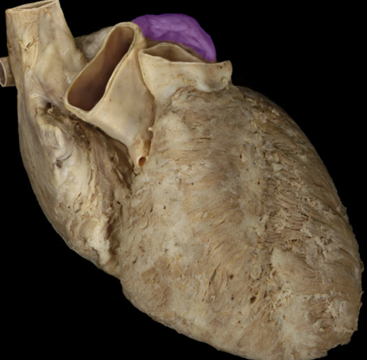 <p>Left auricle</p>