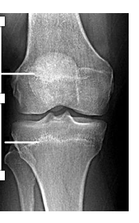 <p>no cartilage present; growth ceased</p>