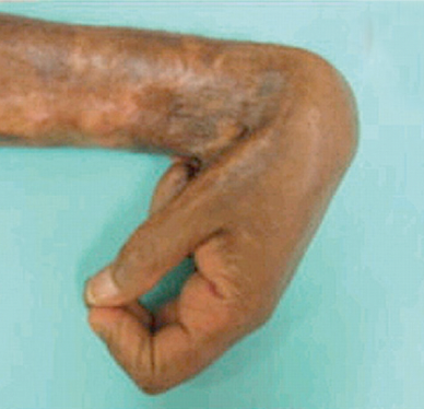 <p>exaggerated contraction of wound that can compromise joint movement; commonly seen after serious burns</p>