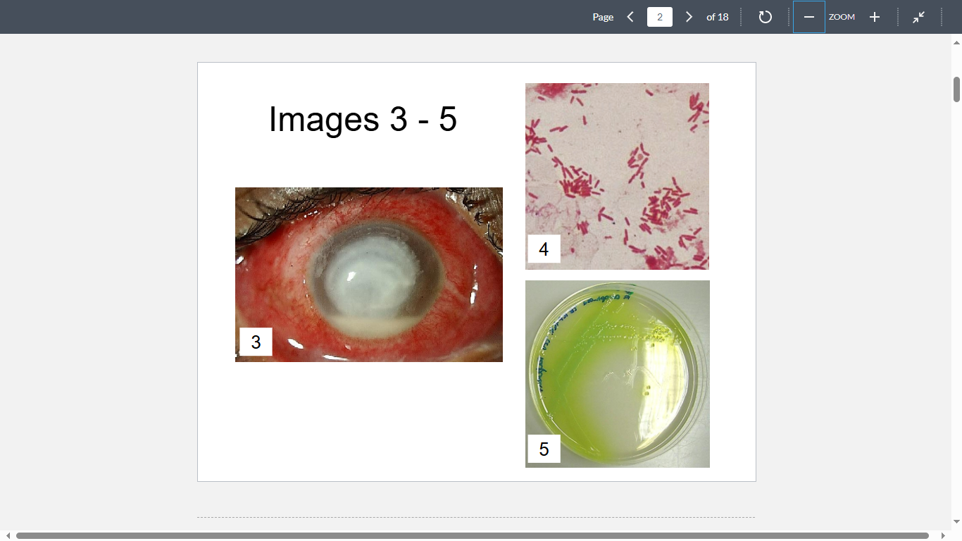 <p>A nine-year-old girl is experiencing pain in her right eye. Upon examination a corneal infiltrate with corneal edema was noted (Image 3). Corneal scrapings were cultured for bacteria and revealed the following organism (Images 4&5). What is the most likely cause?</p>