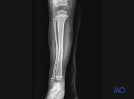 <p>bone doesnt shatter all the way thru</p>