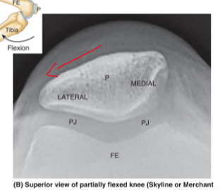 <p><strong>laterally</strong> because of the angle of the quads and patella creating an outward pull</p>