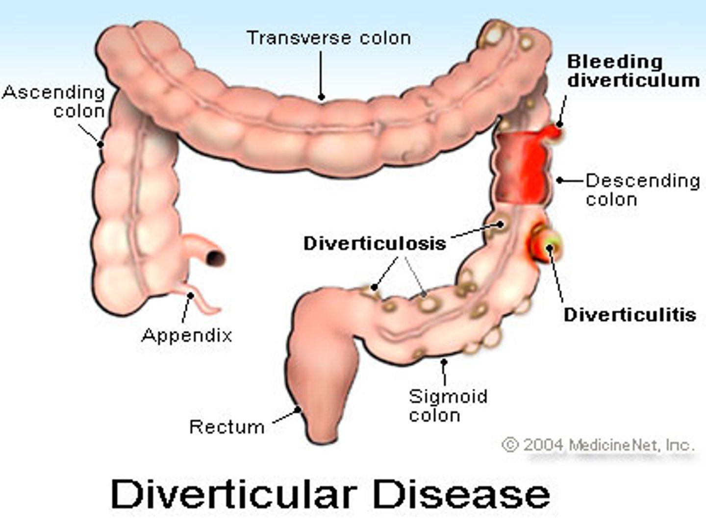 <p>Inflammation of diverticula in the colon.</p>
