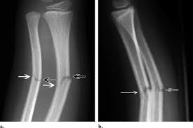 <ul><li><p>INCOMPLETE break in the bone </p></li><li><p>bone can crack or bend on only one side </p></li><li><p>“like a twig when it breaks, it doesn’t break all the way/completely at first—hence the name”</p></li></ul><p></p>