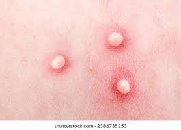 <p>pustule</p>