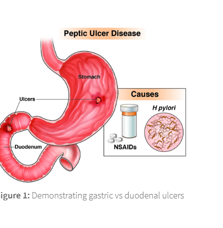 <ol><li><p>increased acid production- leads to damage of the mucosal lining</p></li><li><p>2 damaged mucosal defences- damage to the natural defences that protect the stomach lining from acid</p></li></ol><p></p>