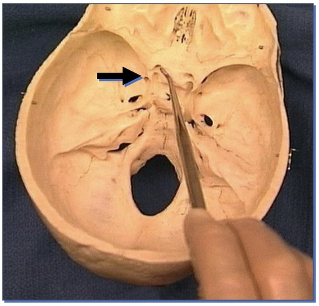 <p>1. Small round opening in sphenoid bone</p>