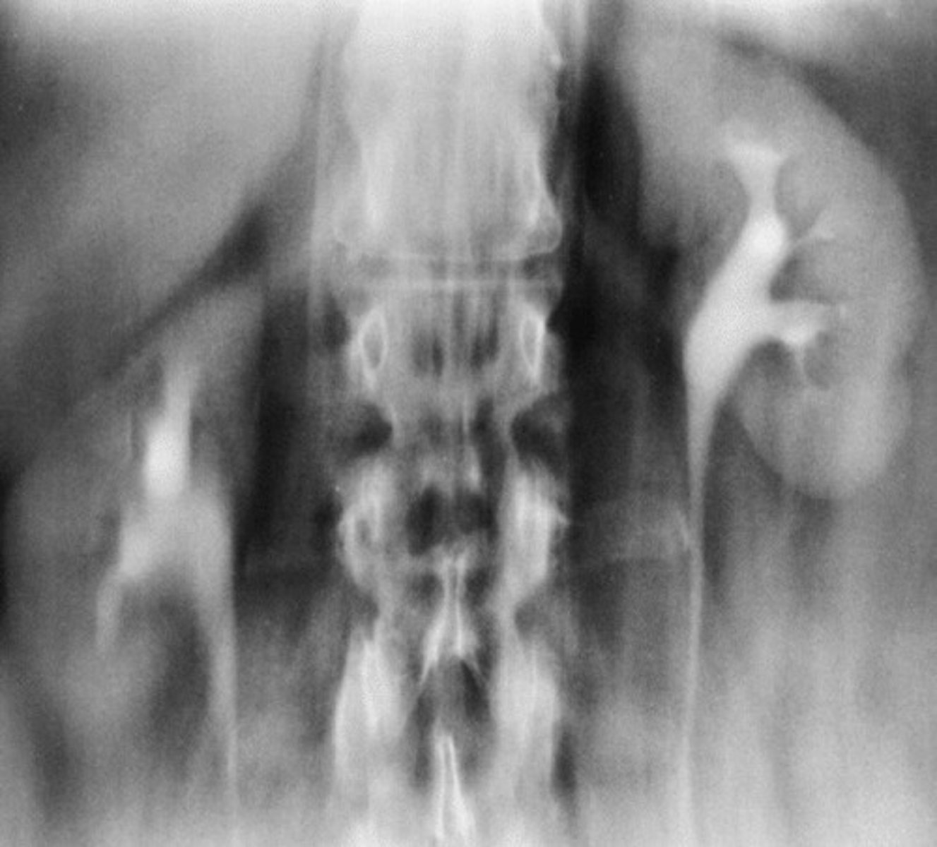 <p>- What pathology refers to the inflammation of the glomeruli that results in albumin and red blood cells in the urine and oliguria?</p><p>- What part of the kidney increases in size?</p><p>- When does this pathology usually occur?</p><p>- What bacteria commonly cause this pathology?</p>