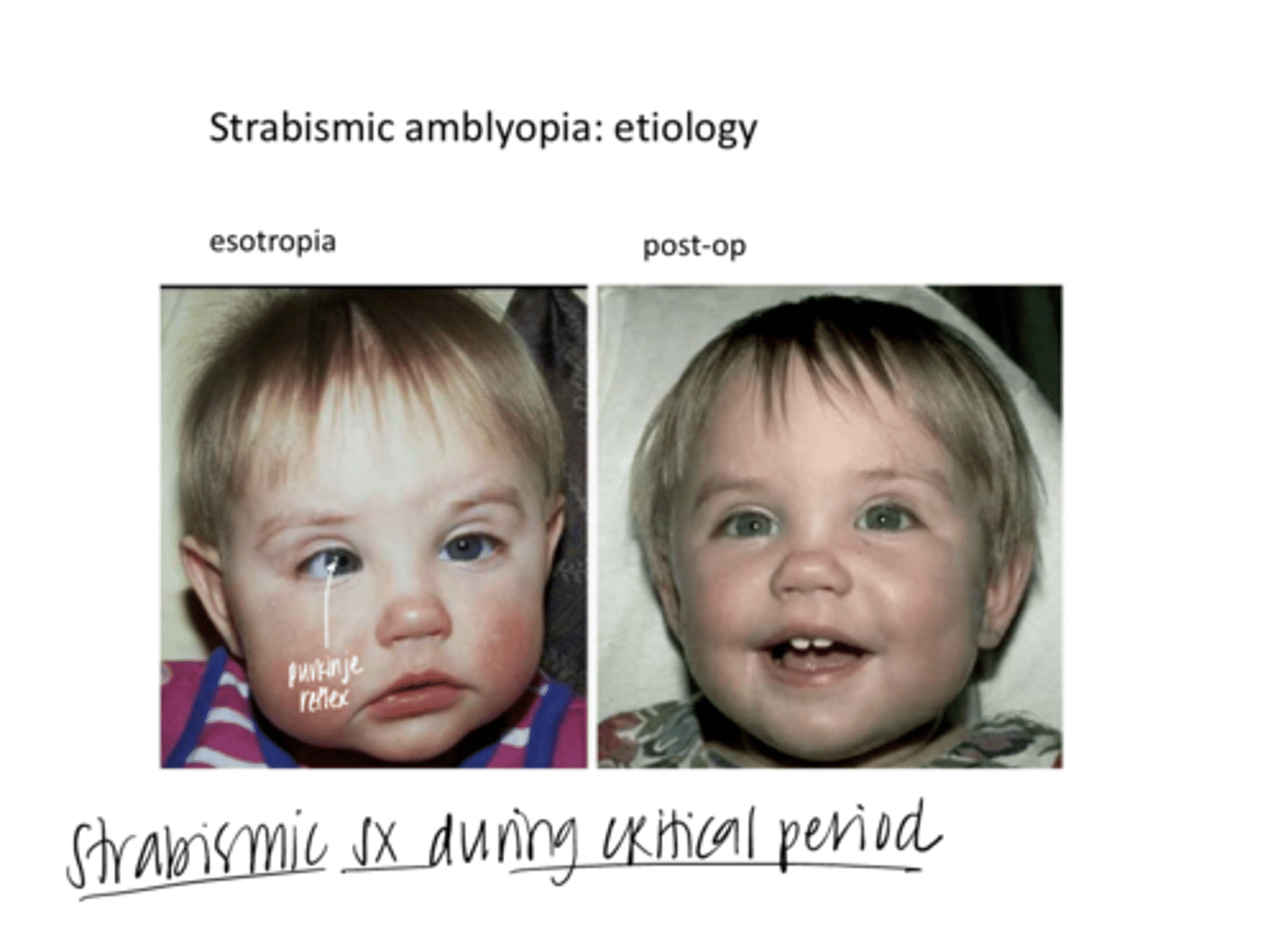 <p>Strabismic Sx During Critical Period (Pic)</p>