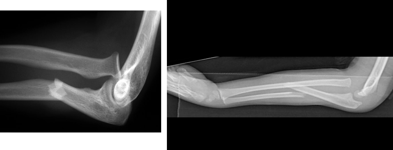 <p>Name this fracture</p>