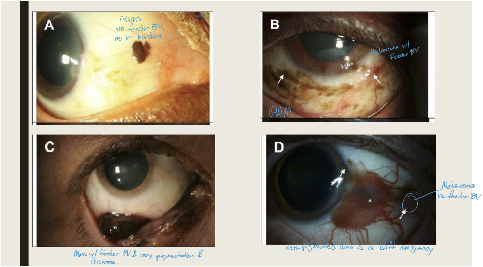<p>It is uncommon, accounting for ~2% of all ocular tumors, and usually presents in the sixth decade of life.</p>