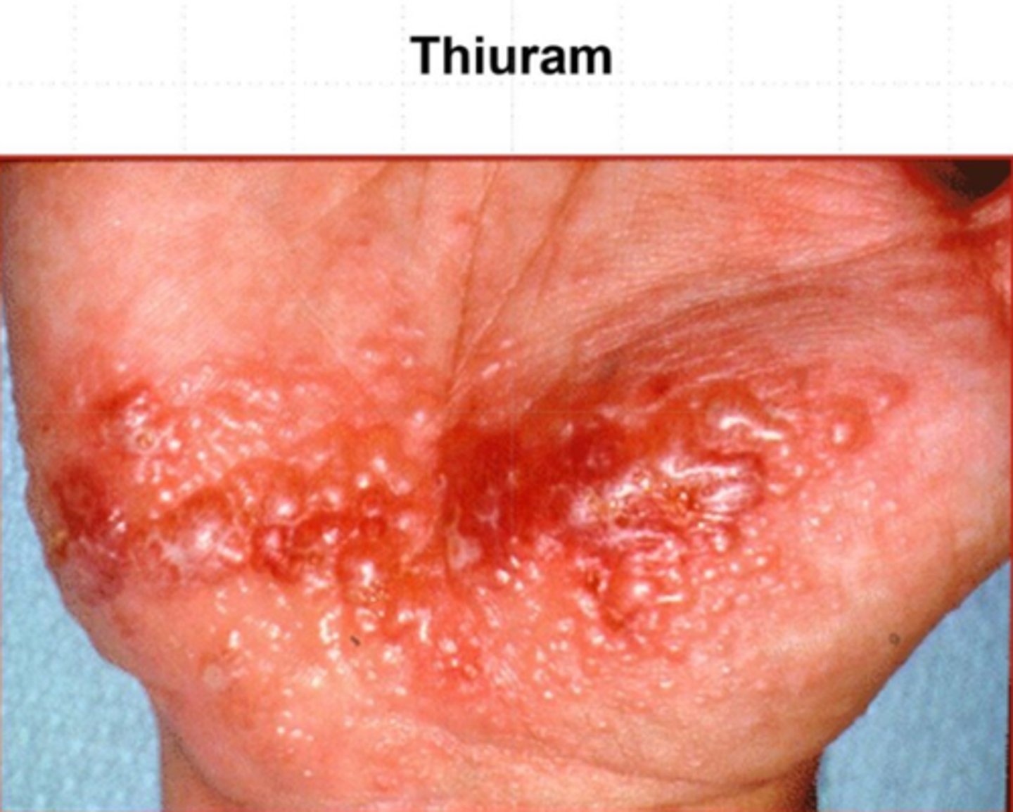 <p>-eosinophil activation, triggered by Th2 type immune response<br>-seen in chronic asthma airway remodeling</p>
