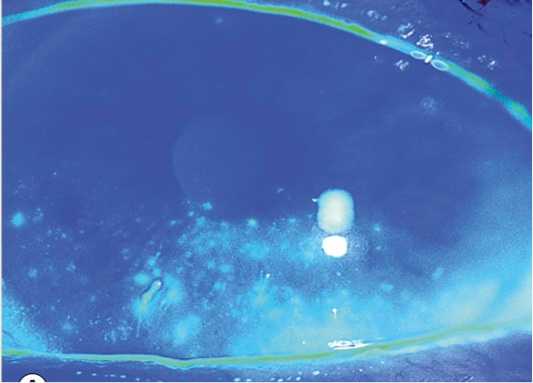 <ul><li><p>tiny epithelial defects</p><ul><li><p>stain with fluorescein or&nbsp;<span>Lissamine Green/Rose Bengal</span></p></li></ul></li><li><p><span>Early sign of corneal compromise</span></p></li><li><p><span>Can be located throughout the cornea (area helps determine cause)</span></p></li></ul><p></p>