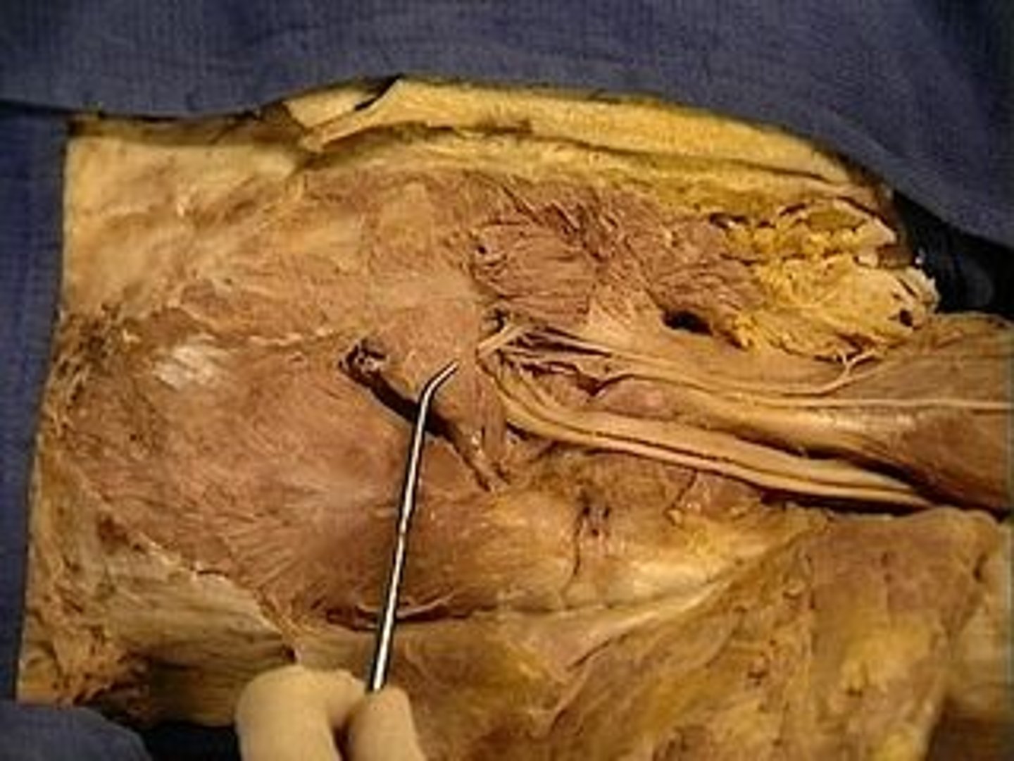 <p>Abducts and laterally rotates thigh at the hip</p>