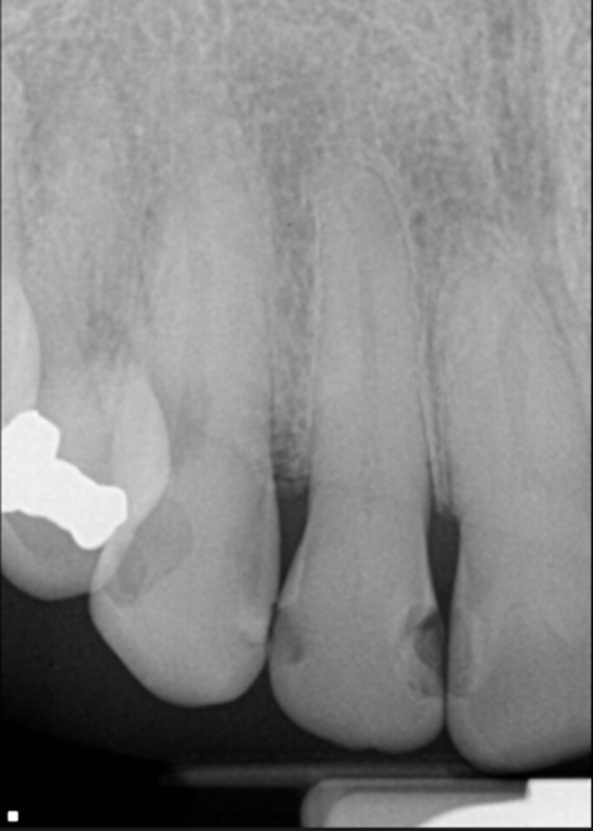 <p>ID the pulpal diagnosis:</p><p>- CC: "My tooth hurts when I drink cold or eat sweets"</p><p>- Cold test: Hypersensitive non lingering (2-3 sec)</p><p>- Radiograph shows defective restoration</p>