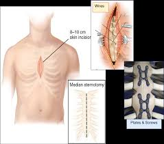 <p>for <span>cardiac</span> procedures</p><p>Incision used in <strong>cardiac surgery</strong>, extending from the sternal notch to the xiphoid process.</p>