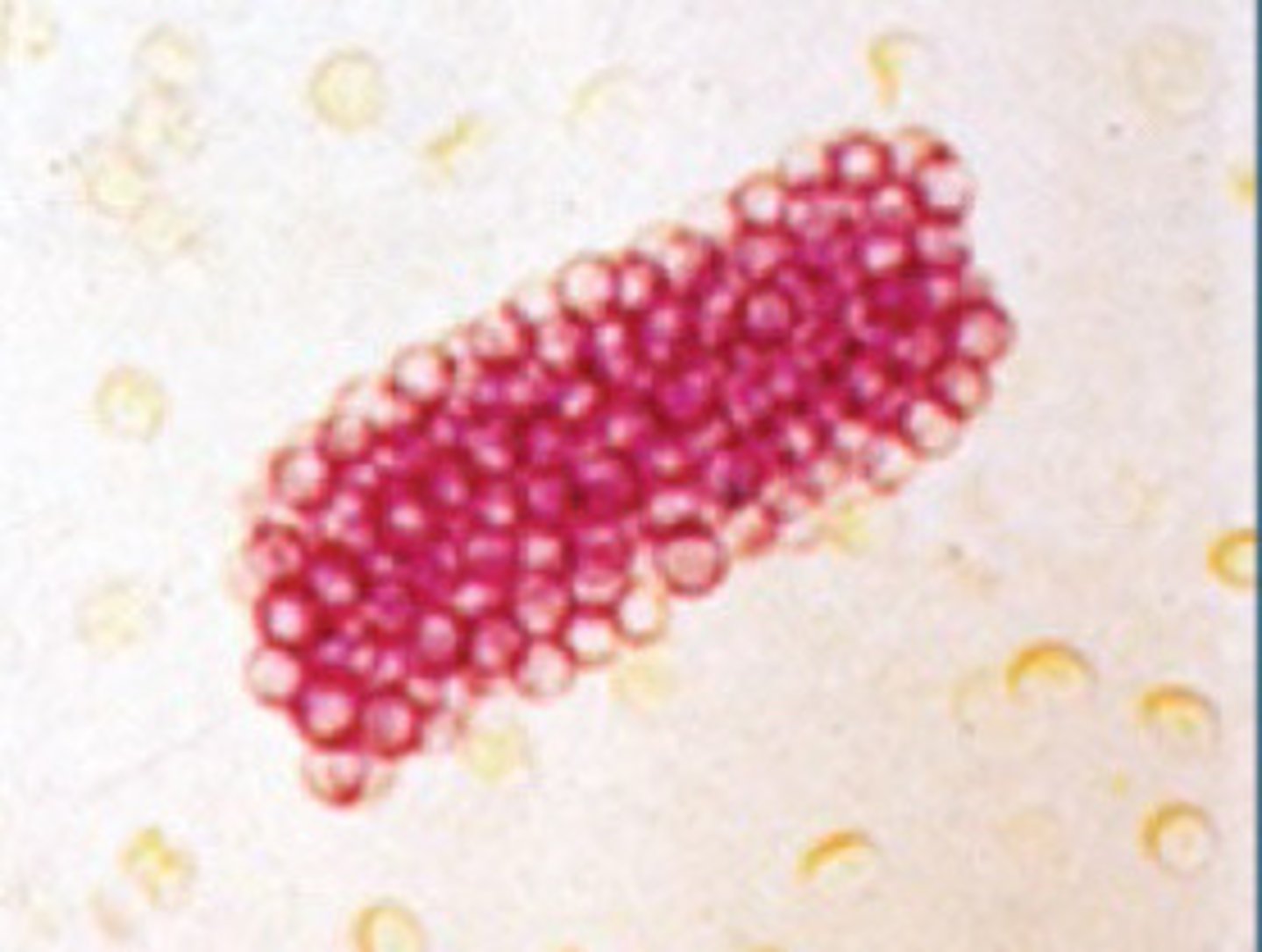 <p>Collection of grouped red blood cells which have leaked into the renal tubules through damage of the glomerular basement membranes.</p><p>Occurs in glomerulonephritis</p>