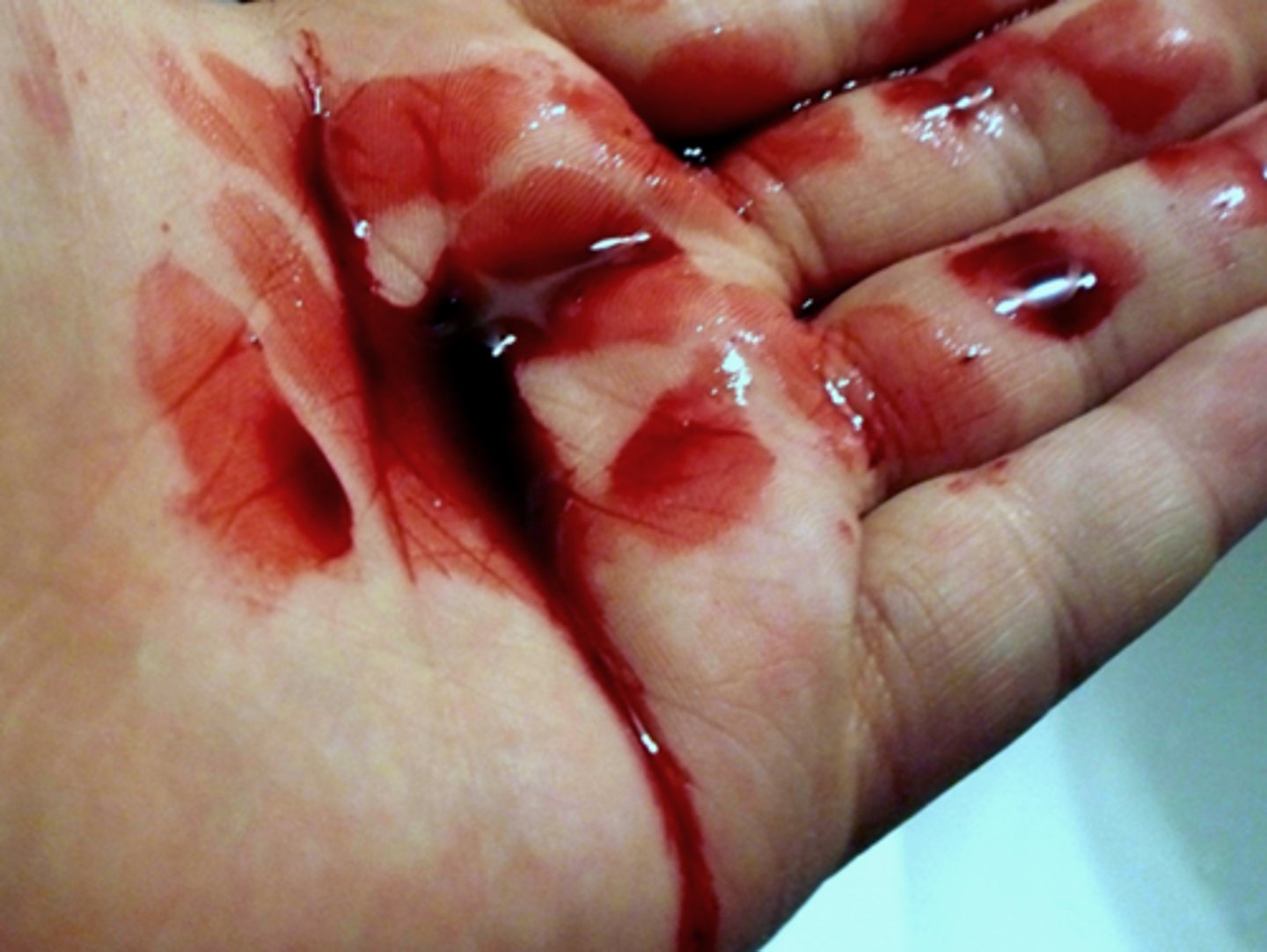 <p>blood condition</p>