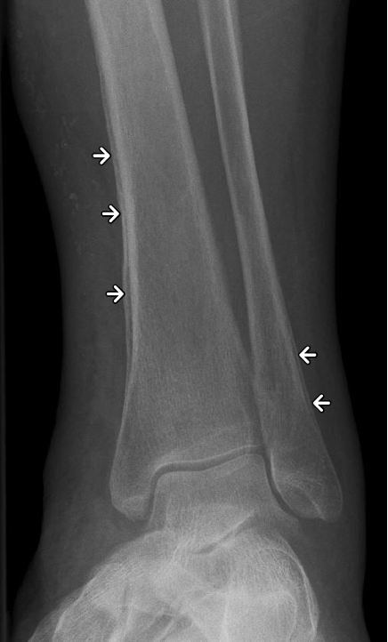 <p>thickening of periosteum - appears white on xray </p><p>seen w/ normal healing fractures, osteomyelitis, benign and malignant tumors </p>