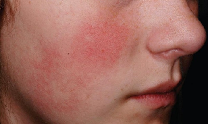 <p>redness associated with heat (blanches with pressure)</p>