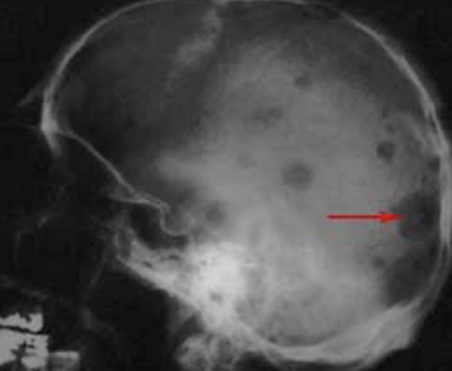 <p>= Malignancy of plasma cells </p><p>- Plasma cells made in the bone marrow </p><p>- Called multiple bc there is more than one lesion </p><p>- Radiographic: Punched out radiolucencies</p><p>- Vertebrae collapse and crush discs, crush nerves --&gt; causes pain (take into account for dental work)</p>