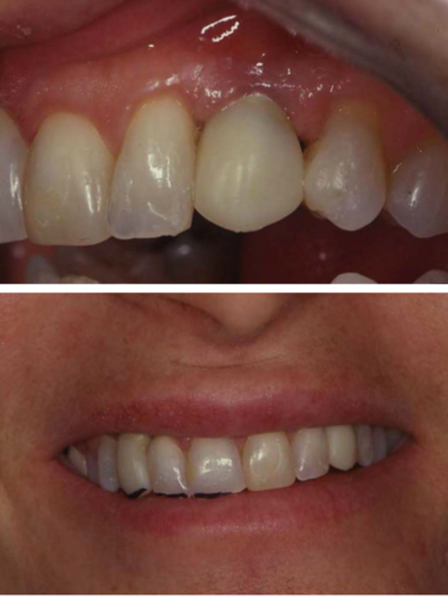 <p>The patient is unhappy about the shade of the canine, what alternative abutment could you suggest?</p>